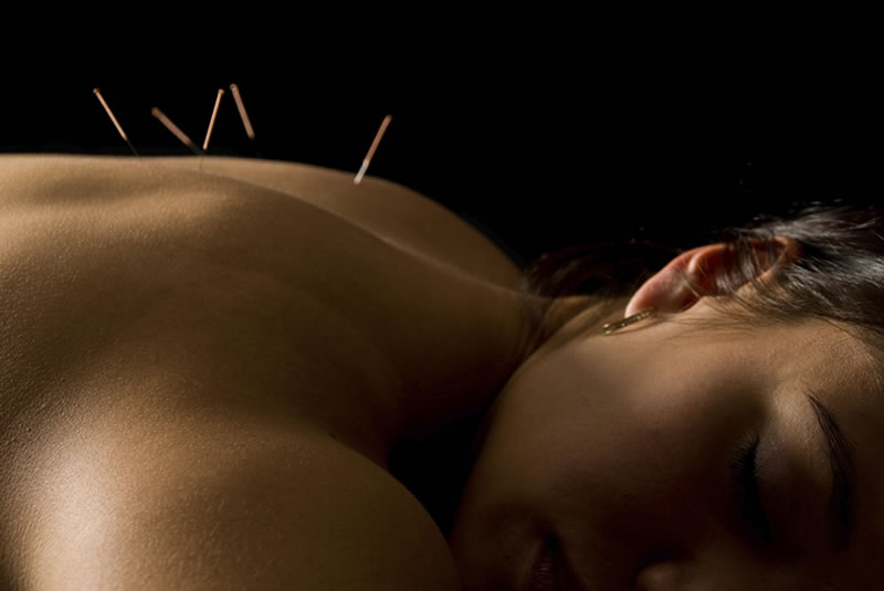 Dry-needling-forli-studio-fisioterapisti