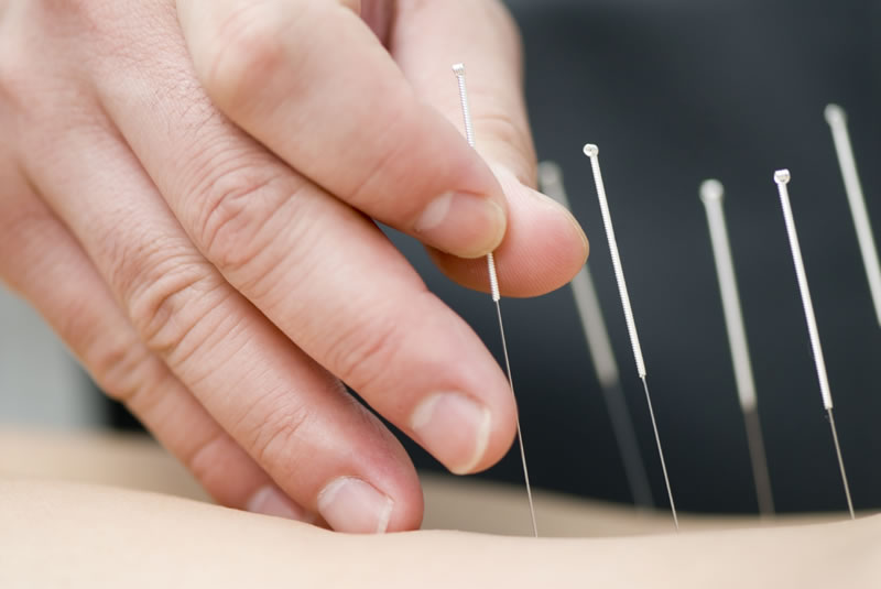 Dry needling forlì